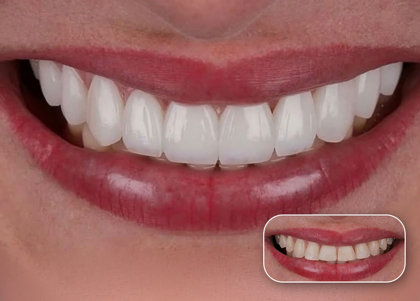 Before and after dental treatment result at a Dental Tourist partner clinic in Albania