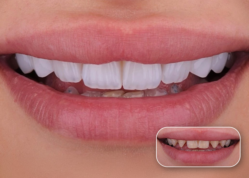 Before and after dental treatment result at a Dental Tourist partner clinic in Albania