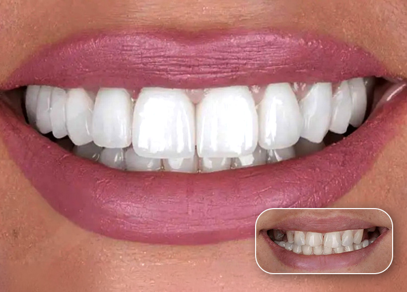 Before and after dental treatment result at a Dental Tourist partner clinic in Albania