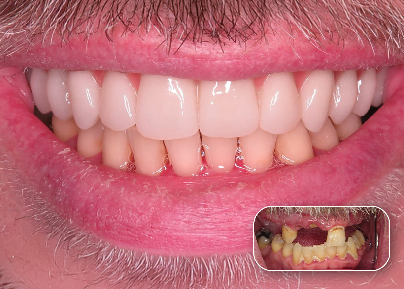 Before and after dental treatment result at a Dental Tourist partner clinic in Albania