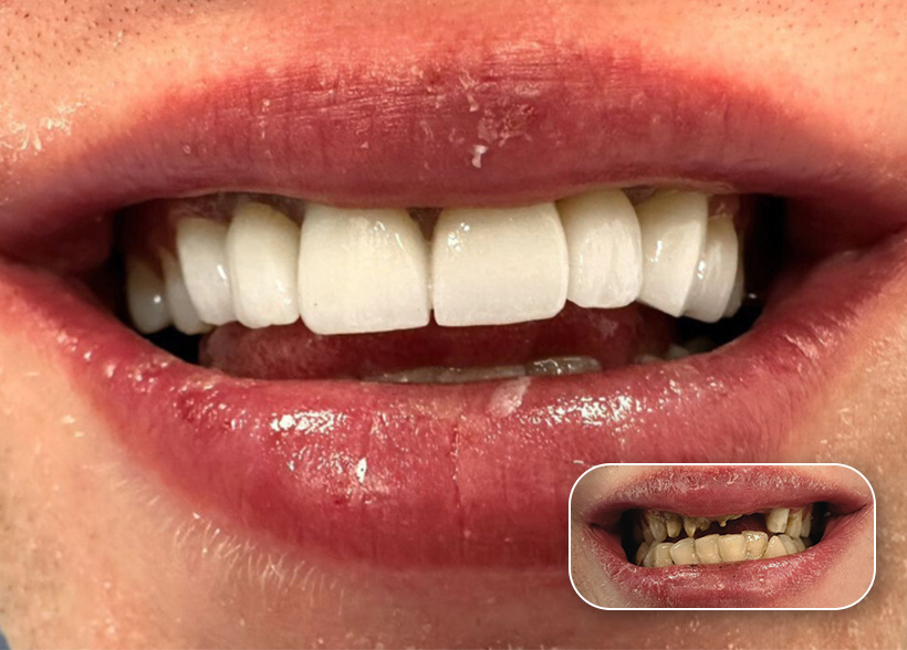 Before and after dental treatment result at a Dental Tourist partner clinic in Albania